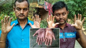 Bangladeş'te parmak izi olmayan adam görenleri şaşırtıyor!