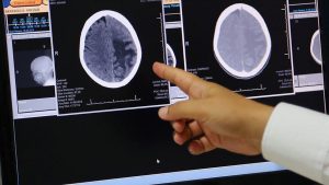 'Beyin tümörü sınıflandırması yapabiliyoruz'