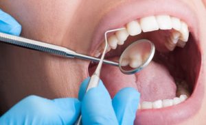 Dişlerde oluşan aşınmaların sebepleri neler diş fırçalama yöntemine dikkat!