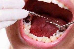 Dişleri çürükten korumanın yolları