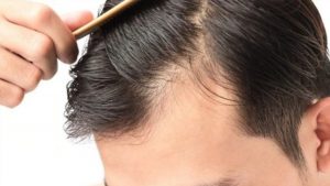 Erkeklerde ve kadınlarda saç dökülmesi nasıl önlenir?