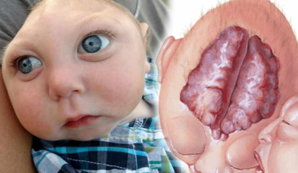 Anensefali nedir? Bebek ve çocuklarda Anensefali belirtileri neler? Anensefali nedenleri...