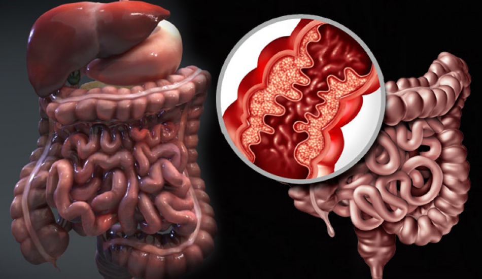 Crohn hastalığı nedir? Crohn hastalığının belirtileri nelerdir? Crohnun tedavisi var mıdır?