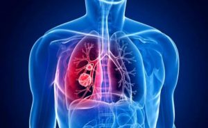 Akciğer kanseri belirtileri nelerdir? Akciğer kanseri birinci evre belirtileri! Akciğer kanseri 4 evre vefat belirtileri nedir?