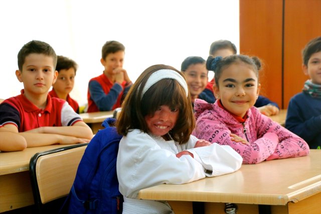 Balık Pulu" Hastası Kızın On Parmağında On Beceri