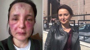 9 yıl süren dava: Hastanın yüzünde iz bırakan düzmece estetikçiye mahpus cezası