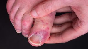 Covid: Birtakım hastaların el ve ayak parmakları neden morarıyor?