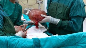 Manisa'da nefes darlığı olan kadının karnından 3 kilo kitle çıktı