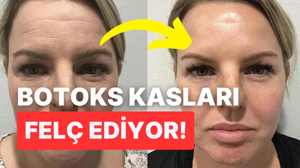 Estetik Yaptırmaktan Çekinmeyenler Dikkat! Botoksun Beyninizde Yarattığı Tesir Ürkütücü Estetik Yaptırmaktan Çekinmeyenler Dikkat! Botoksun Beyninizde Yarattığı Tesir Ürkütücü