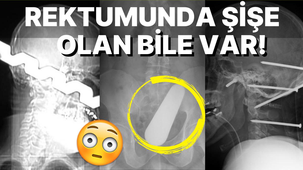 Tuhaflıklarını Görünce Küçük Lisanınızı Yutma Noktasına Geleceğiniz 15 Enteresan Röntgen Sineması