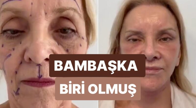 Estetikle Bir Anda 30 Yaş Birden Gençleşen 74 Yaşındaki Bayanın İnanılmaz Değişimi