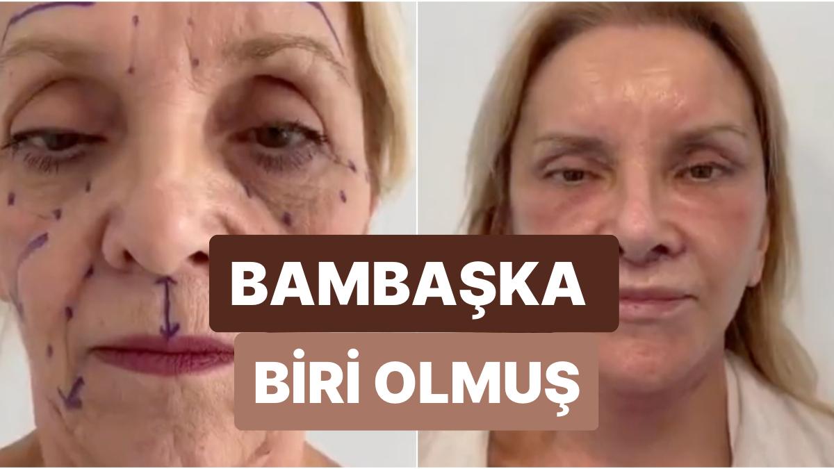 Estetikle Bir Anda 30 Yaş Birden Gençleşen 74 Yaşındaki Bayanın İnanılmaz Değişimi Estetikle Bir Anda 30 Yaş Birden Gençleşen 74 Yaşındaki Bayanın İnanılmaz Değişimi