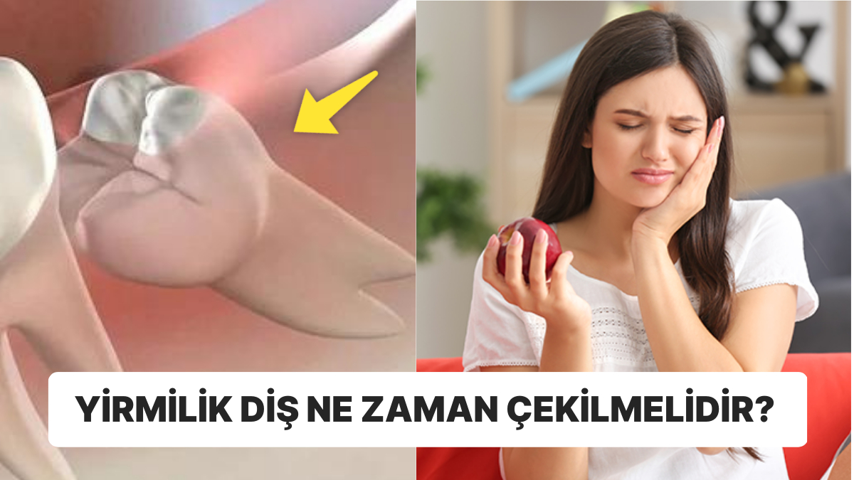 Ağrısıyla Uykusuz Gecelere Sebep Olan Yirmilik Diş Hakkında Bilmeniz Gerekenleri Açıklıyoruz