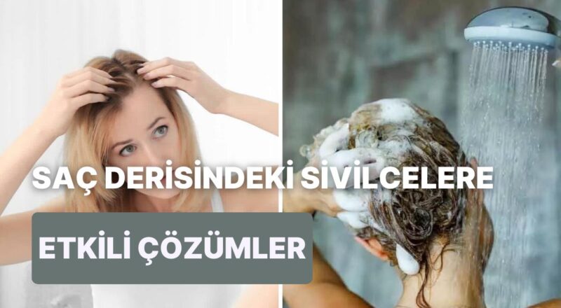 Saç Tabanında Çıkan Sivilcelerin Nedenlerini Anlatıyoruz