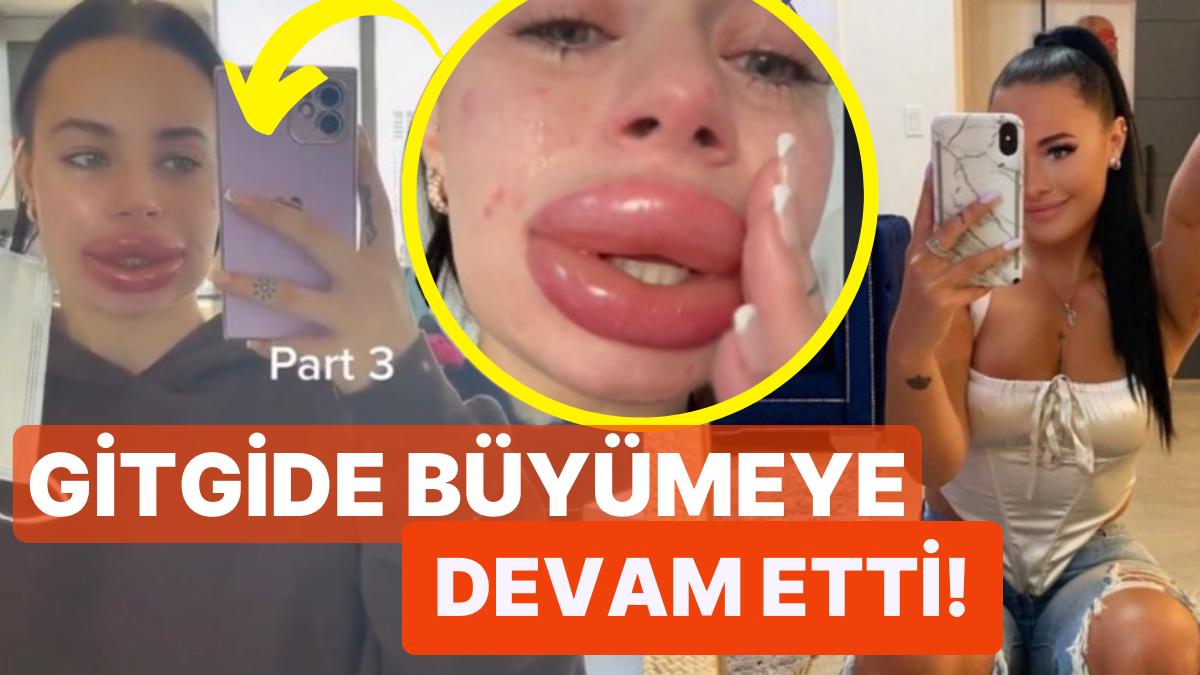Bir Hekimin Yaptığı Çekilişten Parasız Dudak Dolgusu Kazanan Bayan Hayatının Pişmanlığını Yaşadı!