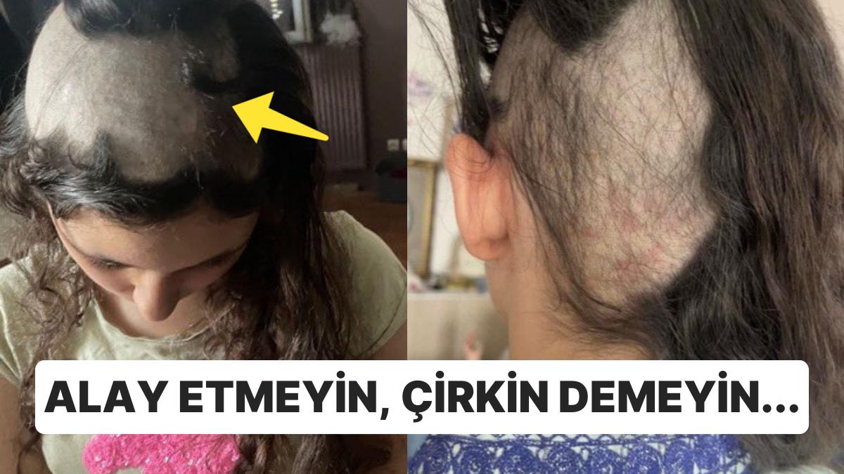 Ruhsal Travma Geçiren İnsanlarda Görülen Saç Yolma Hastalığı Nedir?