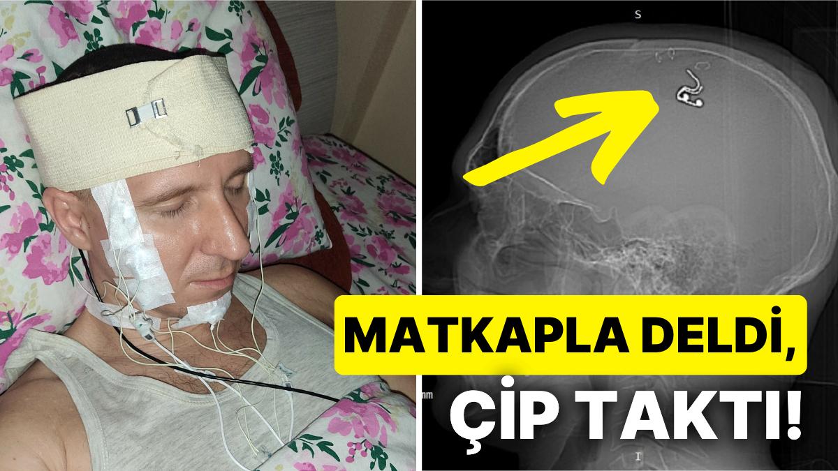 Rusya'da Bir Vatandaş Düşlerini Denetim Edebilmek İçin Matkapla Başını Delip Çip Taktı! Rusya'da Bir Vatandaş Düşlerini Denetim Edebilmek İçin Matkapla Başını Delip Çip Taktı!
