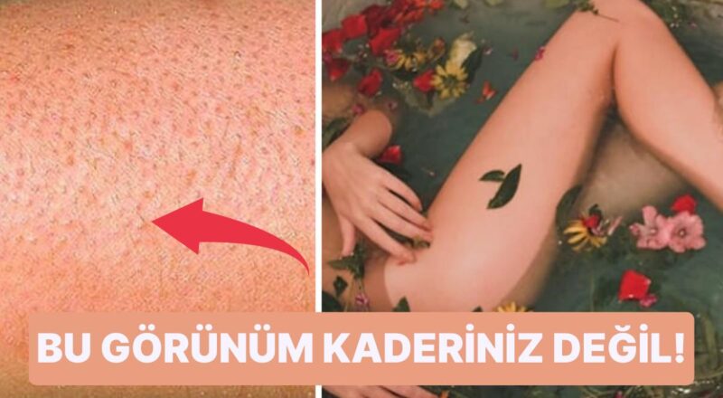 Cildinizdeki Tavuk Derisi Görünümünü Giderebilmek İçin Teklifler