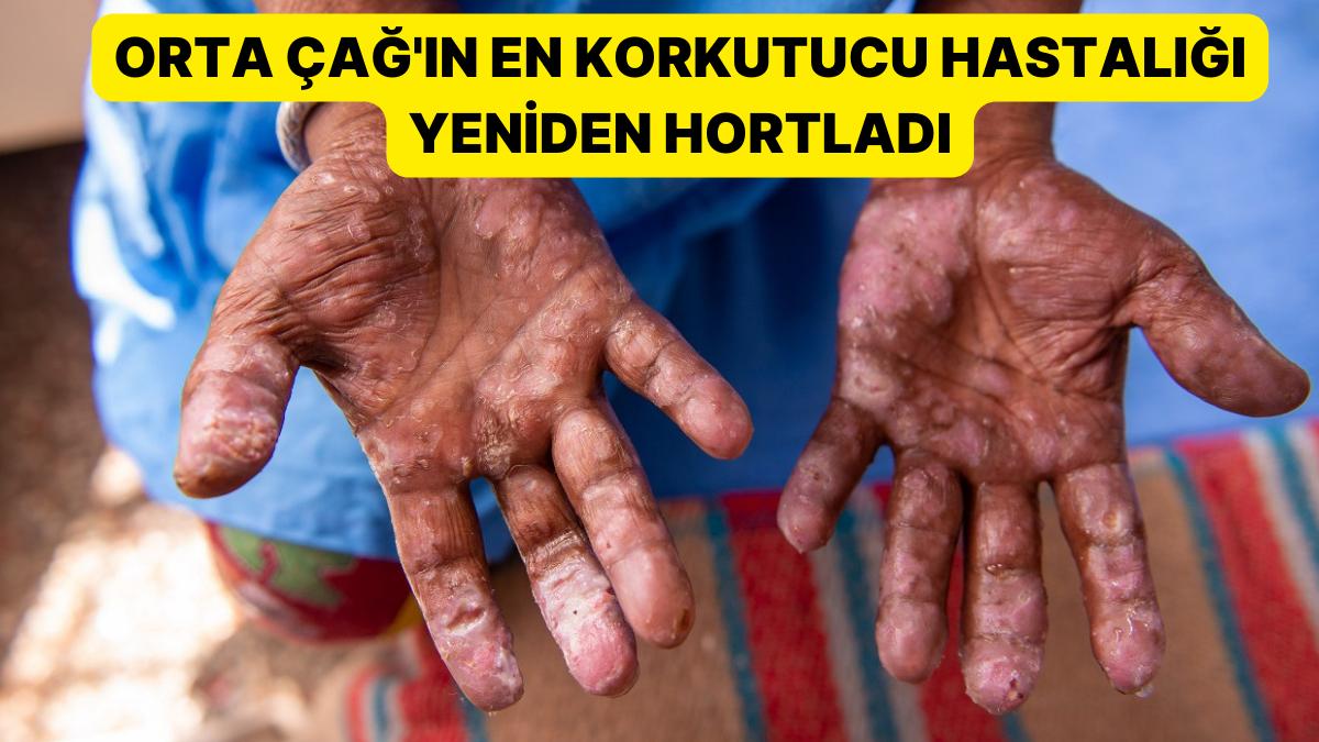 Kâbus Geri Döndü! Her Yıl Yüz Binlerce Hadise: 'Cüzzam Olaylarında Büyük Bir Artış Görüldü' Kâbus Geri Döndü! Her Yıl Yüz Binlerce Hadise: 'Cüzzam Olaylarında Büyük Bir Artış Görüldü'
