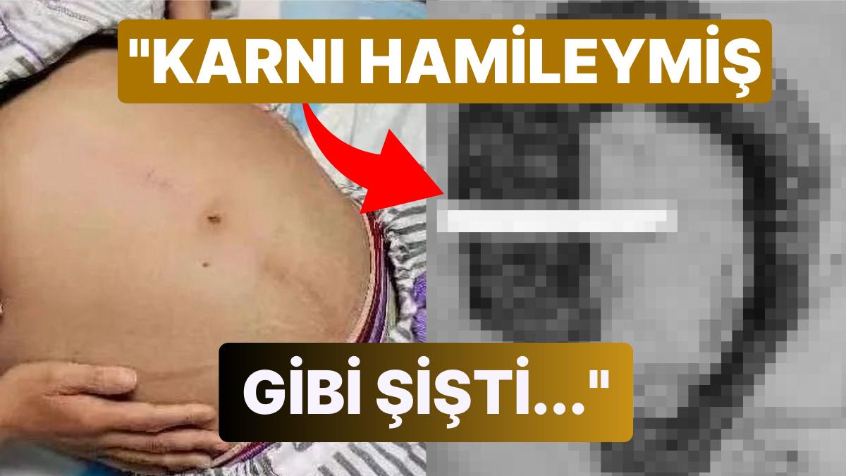 Hekimler 'Piton Yılanına' Benzetti: Kabız Bayandan Ameliyat ile 90 Santimetre Uzunluğunda Dışkı Çıkarıldı